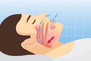 West Palm Beach Post-Operative Respiratory Failure Attorney